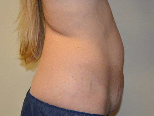 Tummy Tuck Before Patient 5