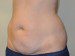 Tummy Tuck Before Patient Thumbnail 2