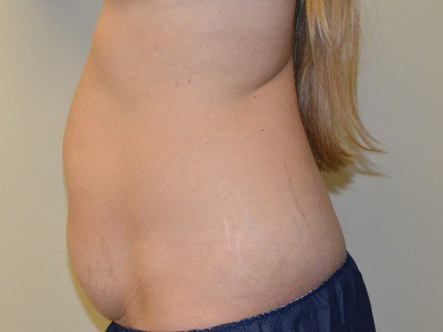 Tummy Tuck Before Patient 3