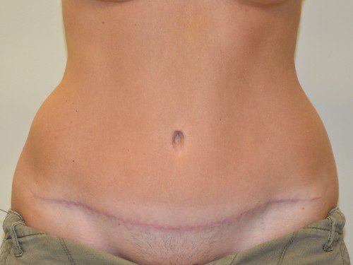 Tummy Tuck After Patient 1