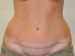 Tummy Tuck After Patient Thumbnail 1
