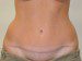 Tummy Tuck After Patient Thumbnail 1