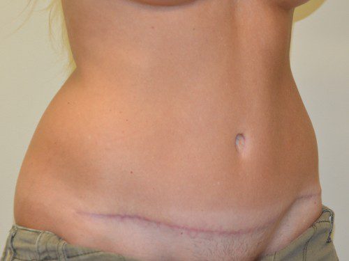 Tummy Tuck After Patient 4