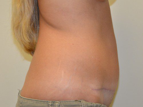 Tummy Tuck After Patient 5