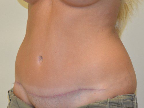 Tummy Tuck After Patient 2