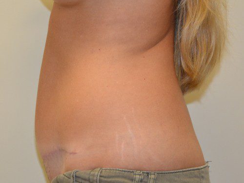 Tummy Tuck After Patient 3