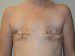 Breast Reconstruction TRAM Flap Before Patient Thumbnail 1