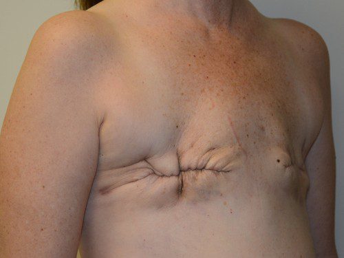 Breast Reconstruction TRAM Flap Before Patient 4