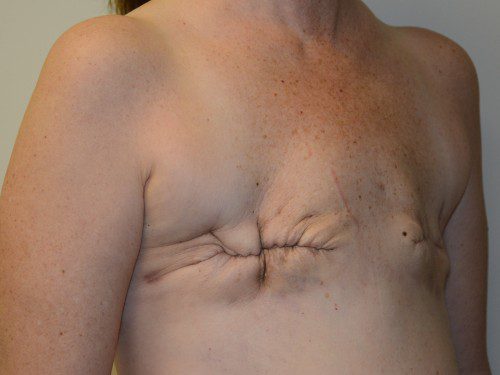 Breast Reconstruction TRAM Flap Before Patient 4