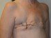 Breast Reconstruction TRAM Flap Before Patient Thumbnail 4