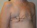 Breast Reconstruction TRAM Flap Before Patient Thumbnail 4