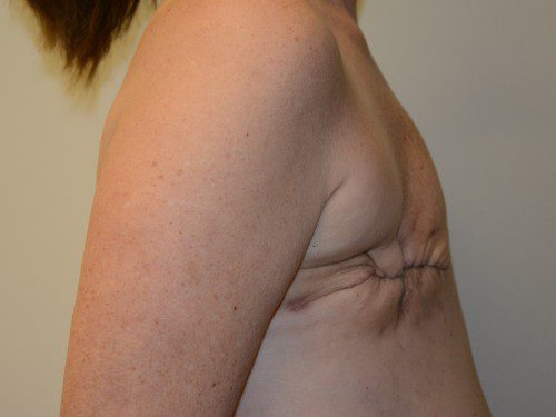 Breast Reconstruction TRAM Flap Before Patient 5