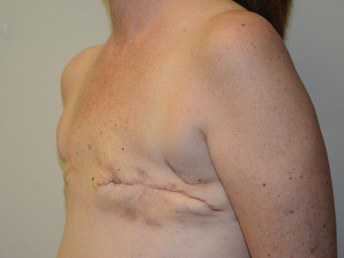 Breast Reconstruction TRAM Flap Before Patient 2