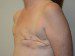 Breast Reconstruction TRAM Flap Before Patient Thumbnail 2