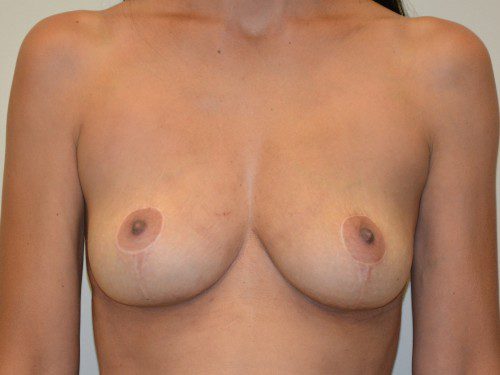 Breast Implant Removal After Patient 1