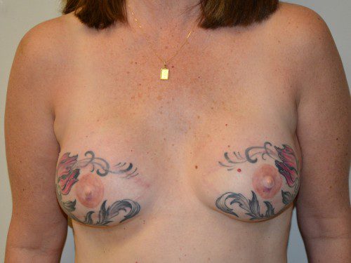 Breast Reconstruction TRAM Flap After Patient 1