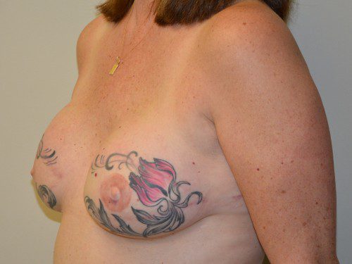 Breast Reconstruction TRAM Flap After Patient 2