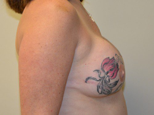 Breast Reconstruction TRAM Flap After Patient 5