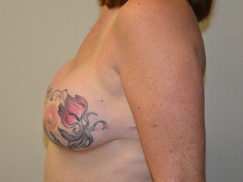 Breast Reconstruction TRAM Flap After Patient 3