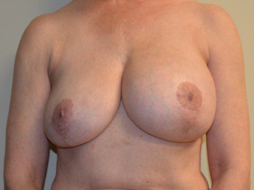 Breast Implant Removal Before Patient 1