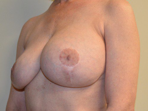 Breast Implant Removal Before Patient 2