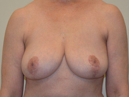 Breast Implant Removal After Patient 1