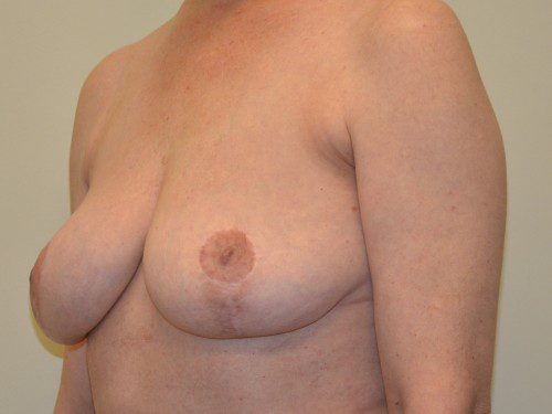 Breast Implant Removal After Patient 2