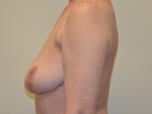 Breast Implant Removal After Patient 3