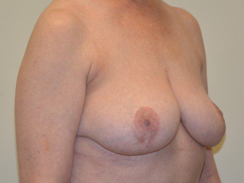Breast Implant Removal After Patient 4