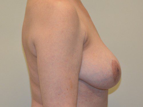 Breast Implant Removal After Patient 5