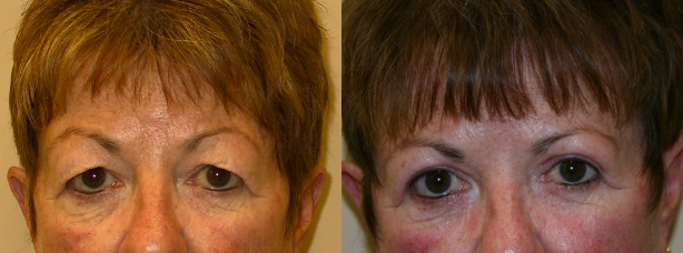 Blepharoplasty Before and After Photos