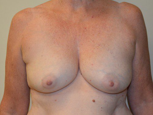 Breast Reconstruction Tissue Expanders Before Patient 1