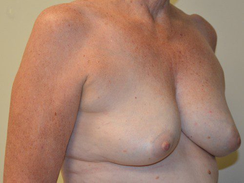 Breast Reconstruction Tissue Expanders Before Patient 4