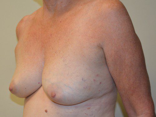 Breast Reconstruction Tissue Expanders Before Patient 2