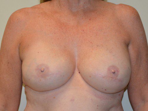 Breast Reconstruction Tissue Expanders After Patient 1