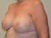 Breast Reconstruction Tissue Expanders After Patient Thumbnail 2