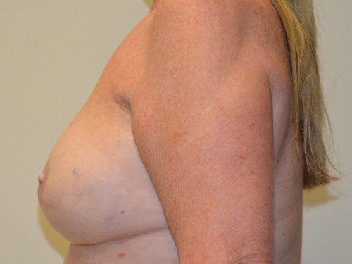 Breast Reconstruction Tissue Expanders After Patient 3