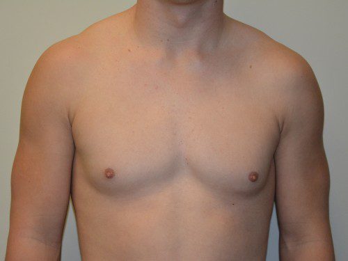 Male Breast Reduction Before Patient 1