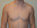 Male Breast Reduction Before Patient Thumbnail 1