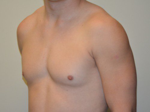 Male Breast Reduction Before Patient 2