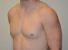Male Breast Reduction Before Patient Thumbnail 2