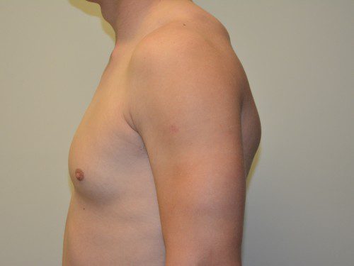 Male Breast Reduction Before Patient 3