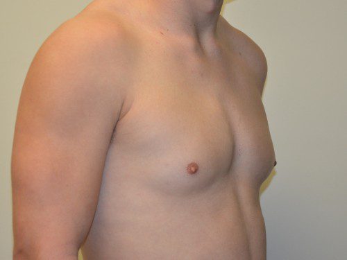 Male Breast Reduction Before Patient 4