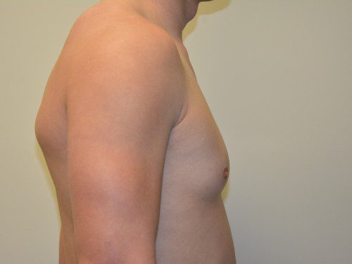 Male Breast Reduction Before Patient 5