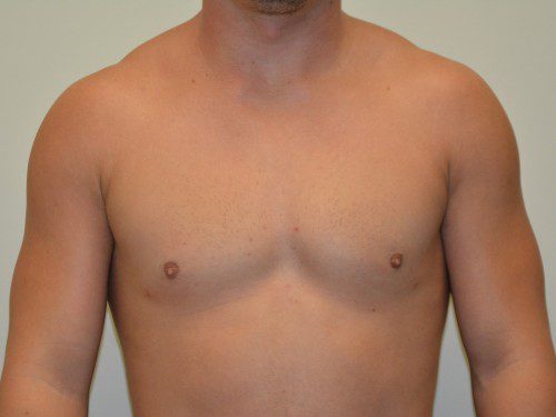 Male Breast Reduction After Patient 1