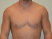 Male Breast Reduction After Patient Thumbnail 1