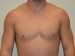 Male Breast Reduction After Patient Thumbnail 1