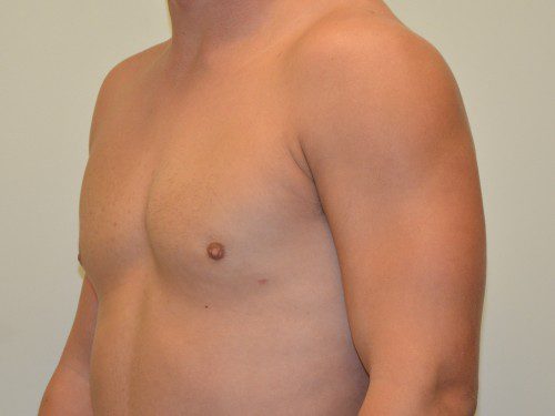 Male Breast Reduction After Patient 2