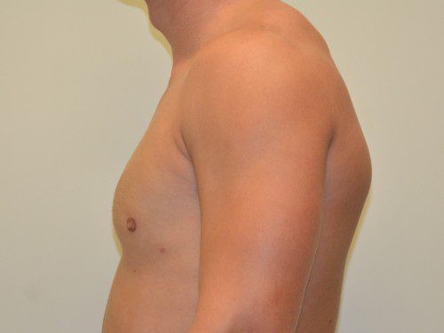 Male Breast Reduction After Patient 3