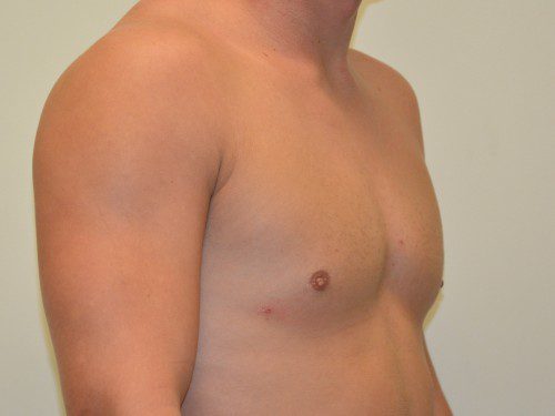 Male Breast Reduction After Patient 4